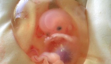 Выкидыш на ранних сроках беременности