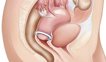 Истмико-цервикальная недостаточность во время беременности